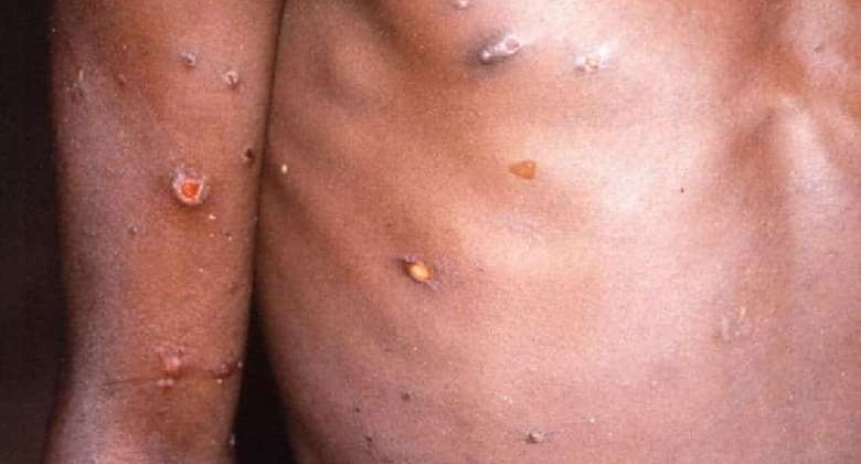 Monkeypox: 9-month-old baby among 18 cases — GHS