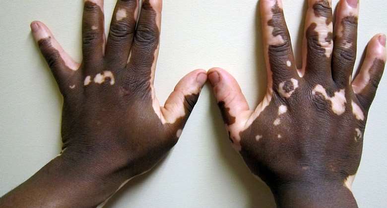 Vitiligo of the hand in a person with dark skin. Copyright: James Heilman, MD wikipedia.org