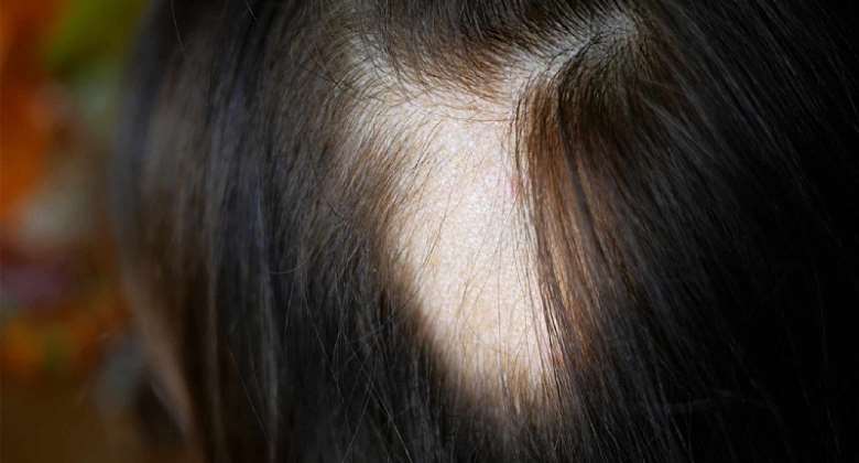 7 Major Causes Of Hair Loss At A Young Age
