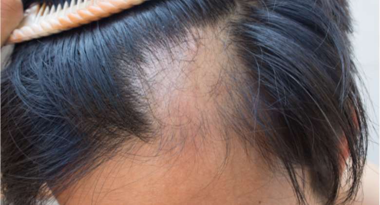 Hair loss Determined by Age