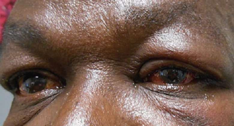 Its not correct to treat apollo with breastmilk - Senior Optometrist