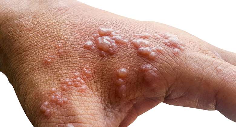 Monkeypox: Ghana records 84 confirmed cases and four deaths