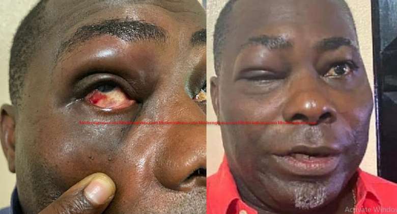 I Did Not Bite MP Mireku's Finger — Charles Bissue Speaks After Bloody Punches