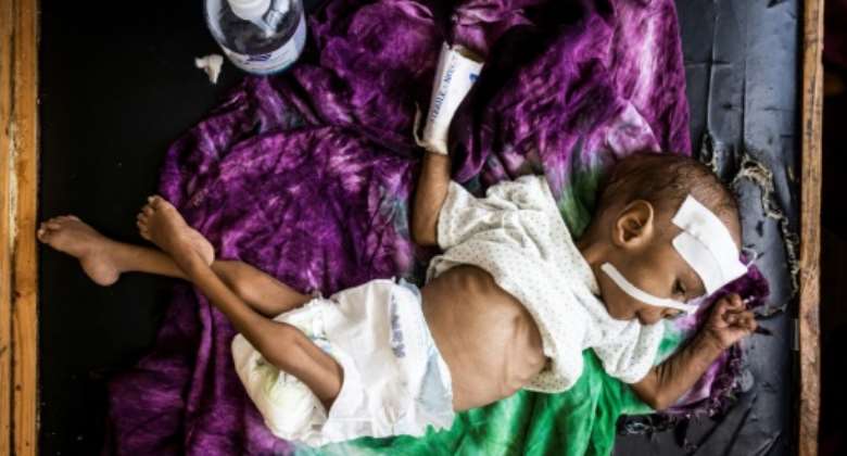 Hunger: A severely malnourished baby at the Banadir Maternity and Children Hospital in Mogadishu, Somalia.  By Ed RAM AFP