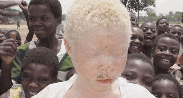 Acts of Discrimination against Albinos: Yusif Fatau’s educational dreams shattered