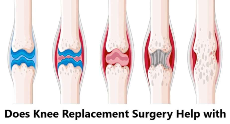 Does Knee Replacement Surgery Help with Rheumatoid Arthritis