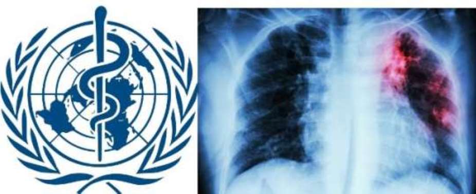 Global actions to end TB epidemic falling far short - WHO warns
