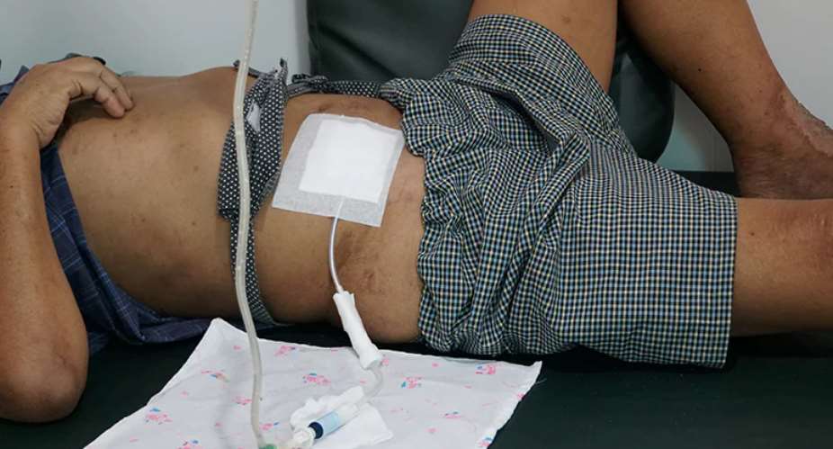 'I'm 100 percent sure peritoneal dialysis is cheaper than hemodialysis; let's adopt it' —Nephrologist reveals