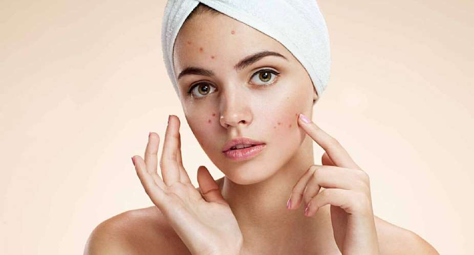 Five Foods That Can Cause Acne