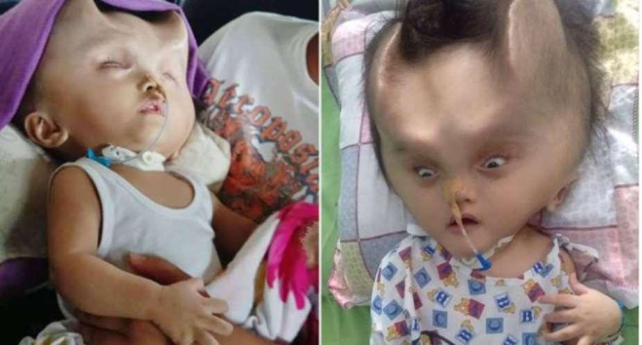 Baby Left With Devil Horns After Surgery