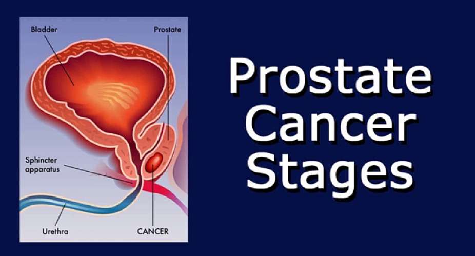 Prostate cancer stages