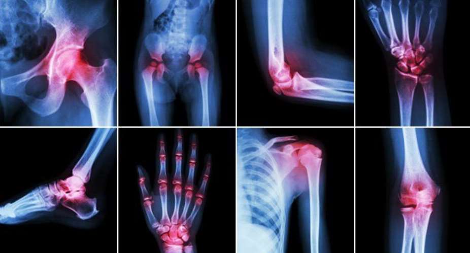 Maintaining Proper Lifestyle And Quality Life Can Help Tackle Arthritis Without Surgery