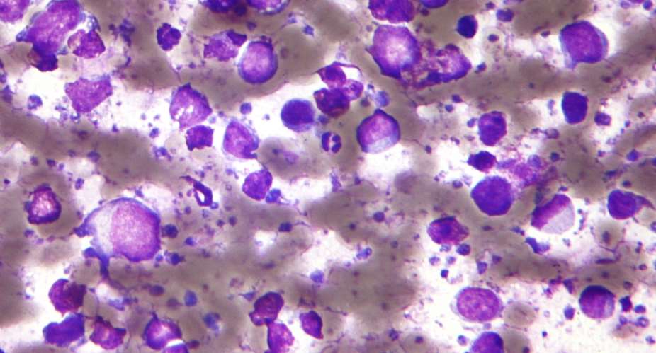 B-Cell Lymphoma: Breakthroughs in Treatment Offer Fresh Hope