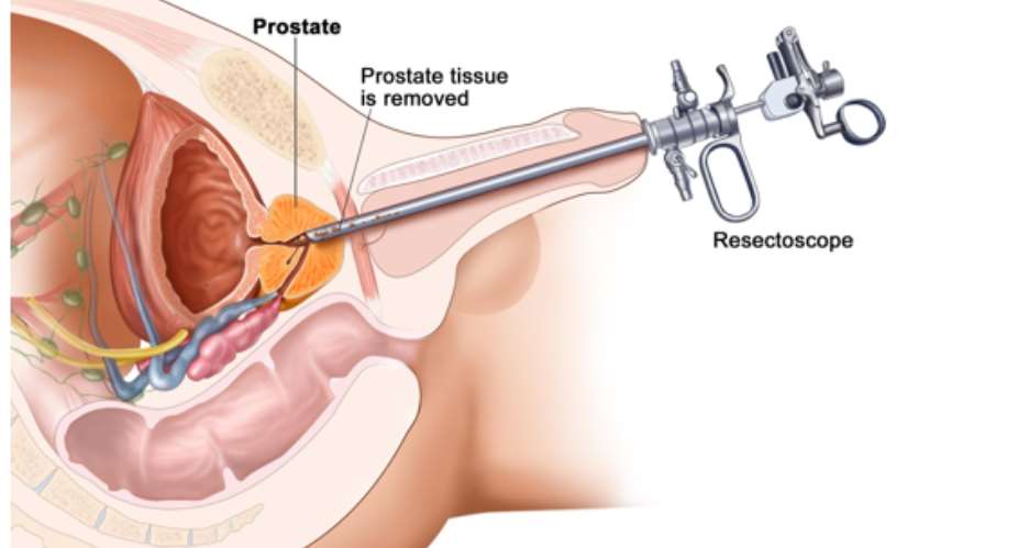 Prostate Cancer: Why Did I Get?