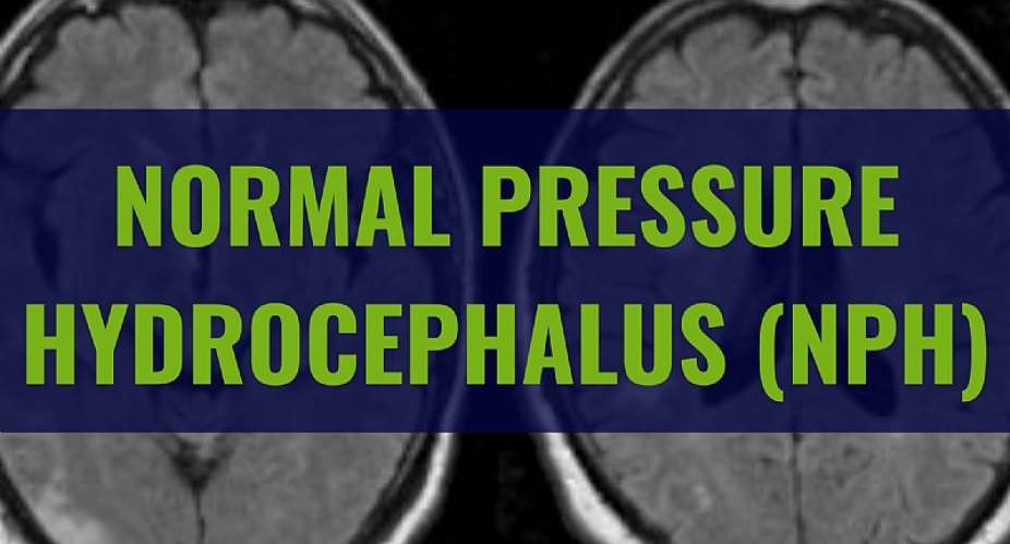 Unlocking Normal Pressure Hydrocephalus: Understanding, Diagnosis and Treatment Options