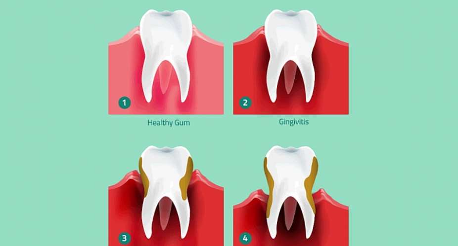 Can Gum Disease Affect Your Fertility?
