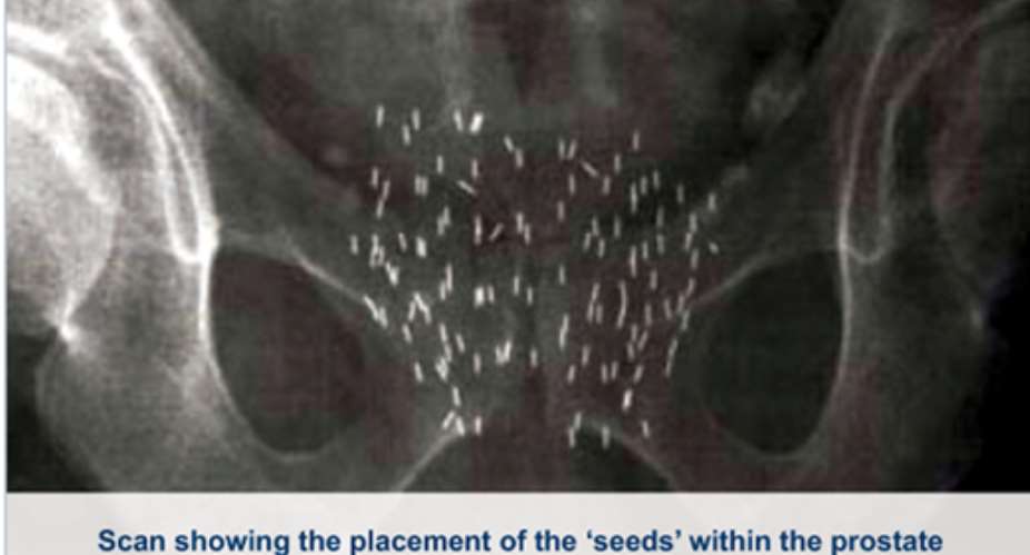 Permanent Seed Brachytherapy For Ghanaian Men