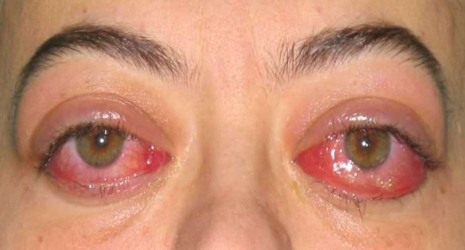 Thyroid Eye Disease: more to it than meets the eye
