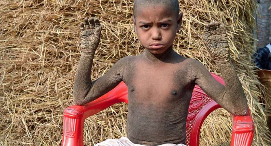 Mehendi Hassan's body is covered in thick, scaly skin, which has led has people to shun him
