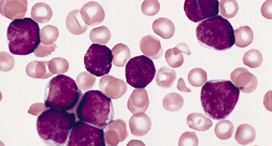 Leukemia: Cancer Of The Blood