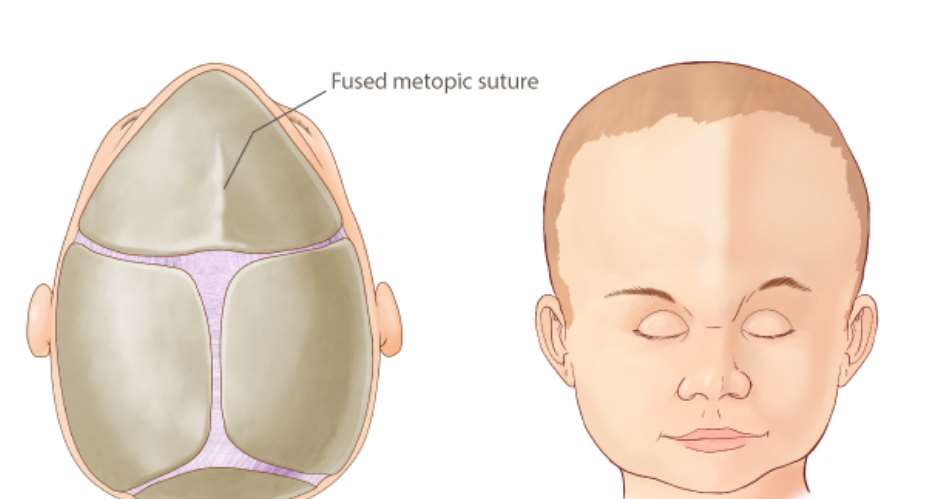 The significance of surgical intervention and raising public awareness regarding craniosynostosis