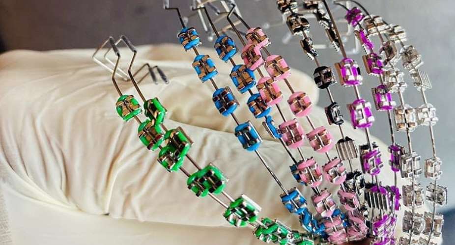 Dentist explains why you should avoid fashion braces