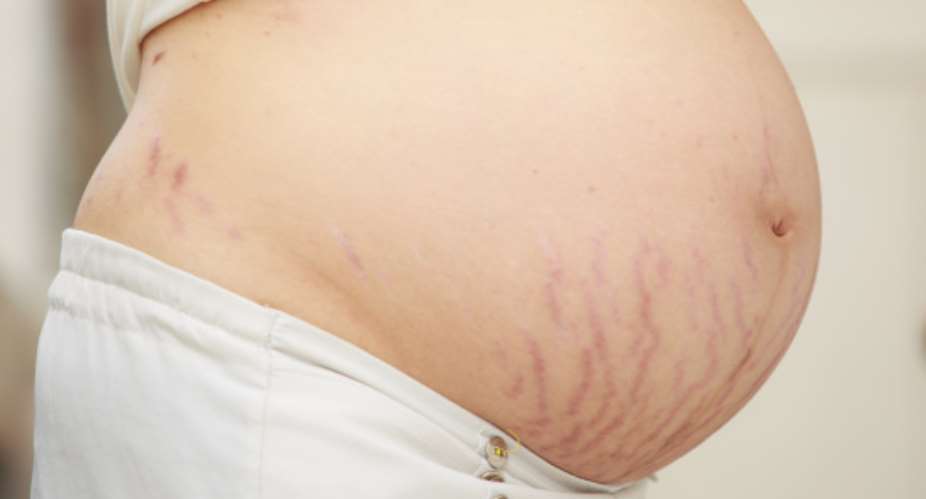 5 Easy Ways To Prevent Stretch Marks During Pregnancy