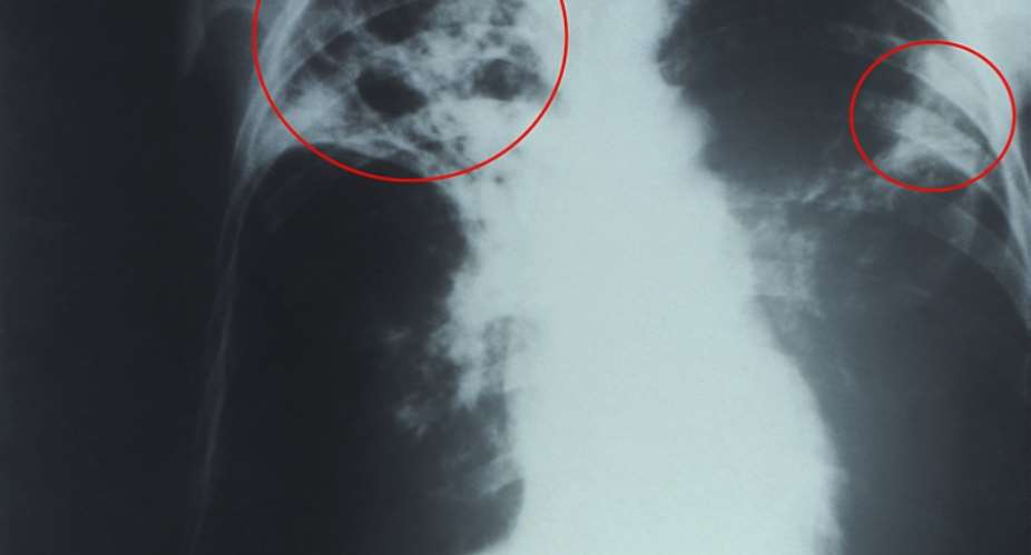 Tuberculosis, Beware of Lung TB.