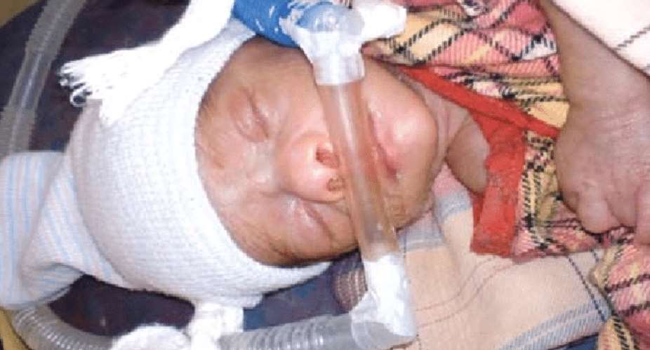 An ill baby on a Continuous Positive Airway Pressure CPAP machine