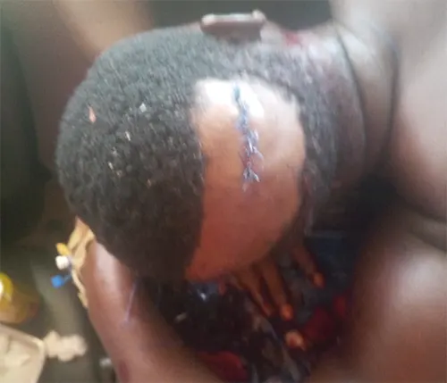 Nana Amankwa Junior, displaying his wounds in the hospital