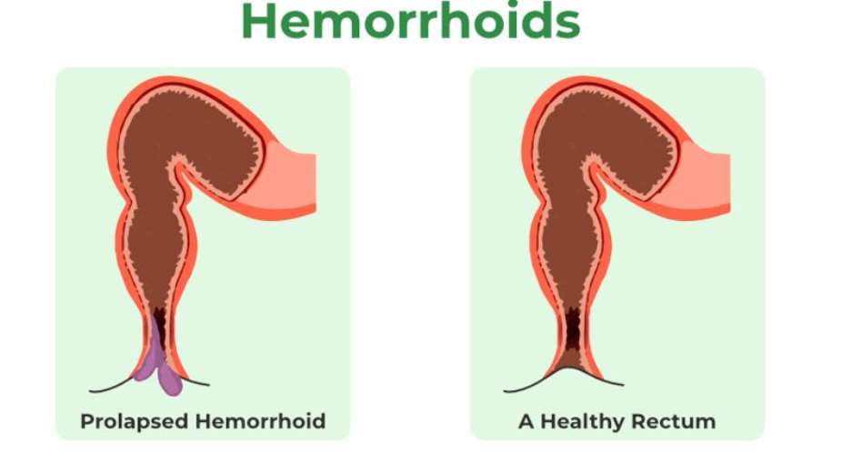 Why My Hemorrhoid Shrinks After Sex: A Physiological Perspective