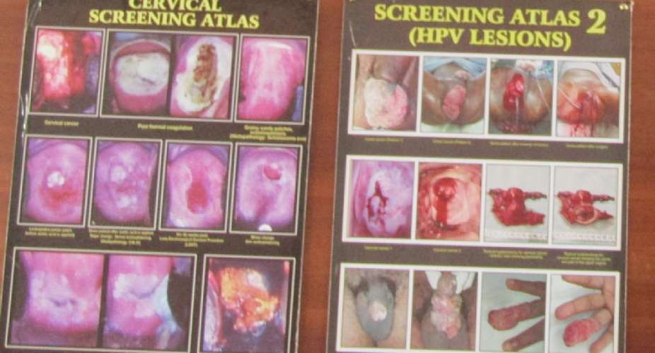 Life cannot be quantified, cervical cancer screening is a must – IMaH Medical Officer