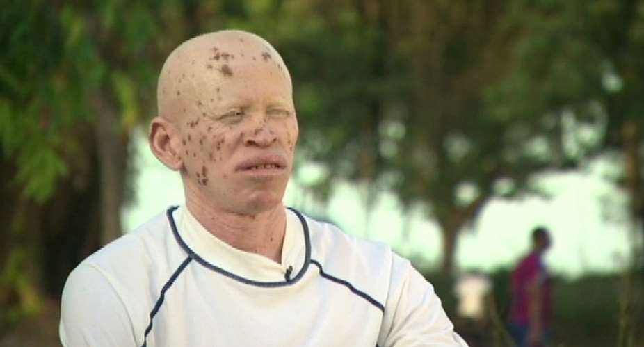 Albinism In Africa: The Struggle For Survival