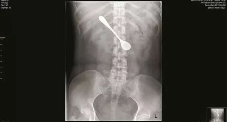 Woman Swallow 5-inch Spoon While Using It To Dislodge Fish Bone Stuck In Her Throat