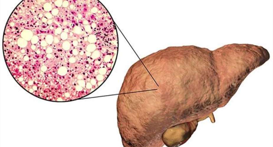 Fatty Liver Disease: A Growing Epidemic