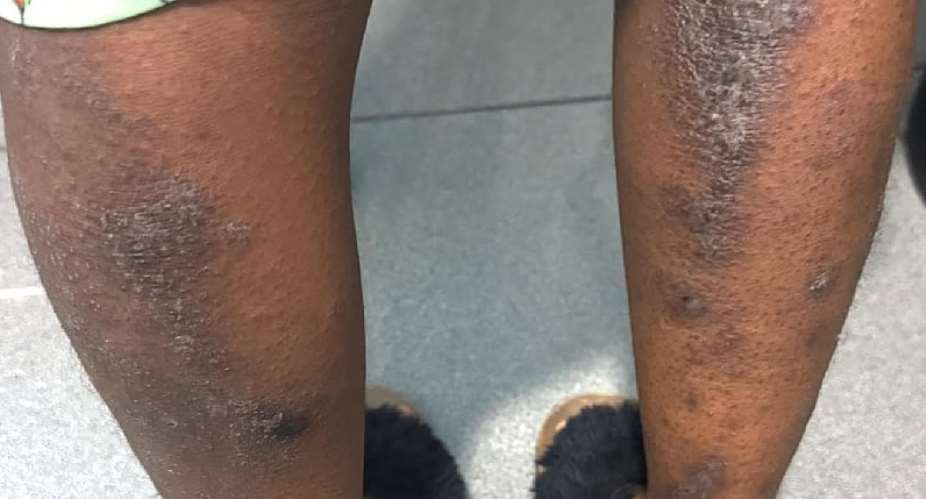 Eczema is not contagious — Ghanaian Dermatologist