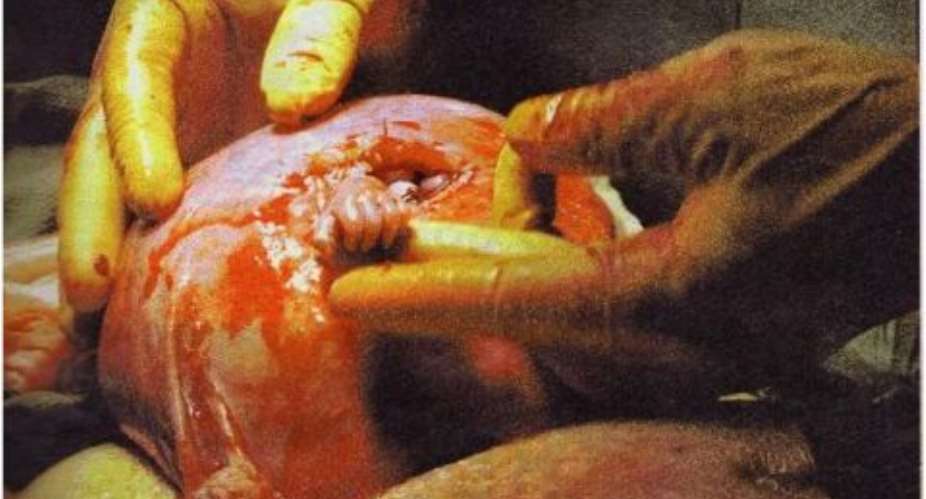 Abortion Is Murder
