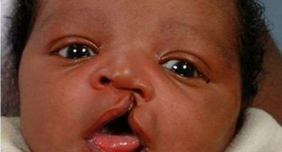 Nutrition key in cleft corrective surgery – Nutritionist