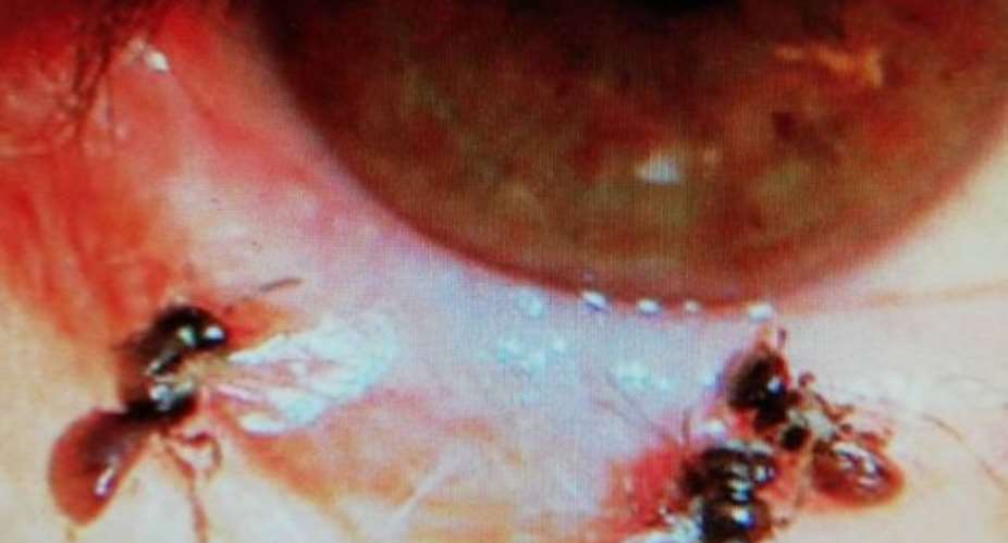 Doctors Find Four Bees Living In Woman's Eye, Feeding On Her Tears