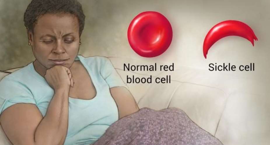 The Doom Of Sickle Cell Disease