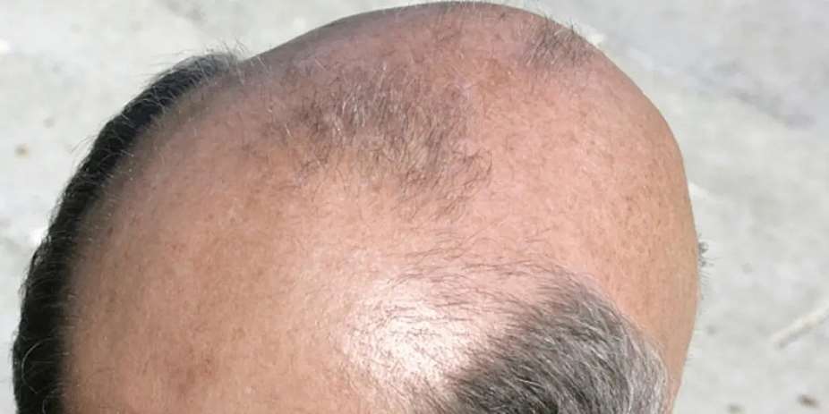 Calling a man bald is sexual harassment – Court rules