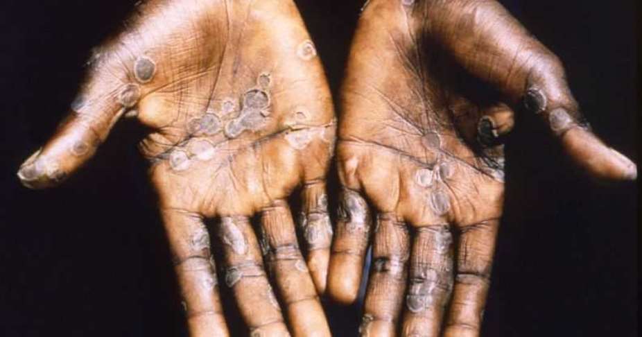 Number of recorded Mpox cases now 3 – GHS