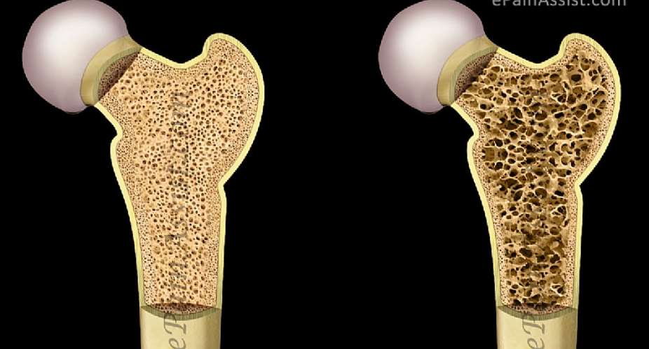 Osteoporosis: The Condition With No Symptoms
