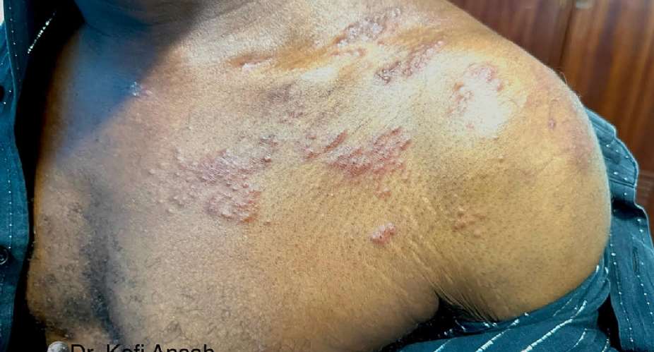 Let’s bridge gap between cultural beliefs and dermatological science – Dr Brifo