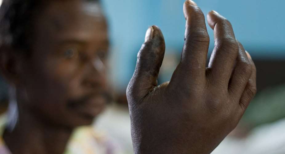 Snakebites can destroy skin, muscle, and even bone – exciting progress on drugs to treat them