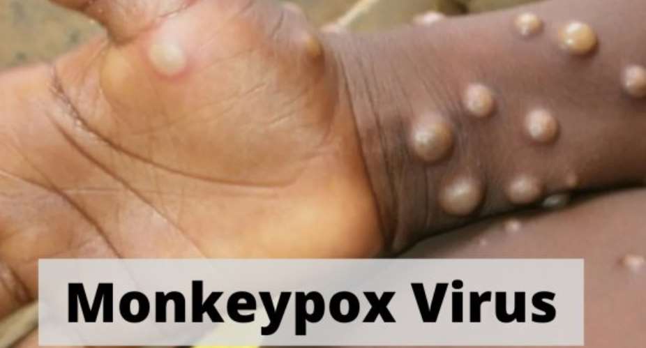 Monkeypox: What you need to know about it