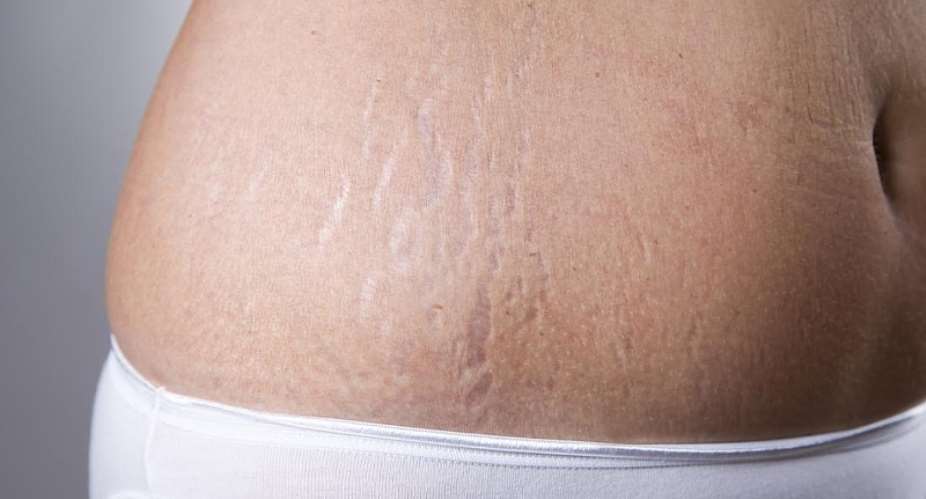Check Out Ways To Get Rid Of Stretch Marks