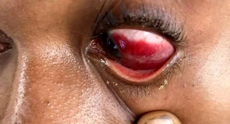 The victim with swelling around his eye