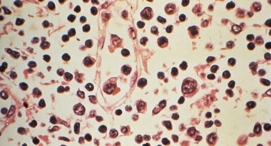 nh chp qua knh hin vi mt m bnh hc trong mt mu hch bch huyt  c ly t mt bnh nhn nghi ng mc bnh This undated handout photo from the US Centers for Disease Control and Prevention (CDC) obtained on May 6, 2026, shows a photograph taken through a microscope showing some of the histopathologic details seen in a lymph node specimen that had been extracted from a patient suspected of a hantavirus illness. - AFP - HANDOUT