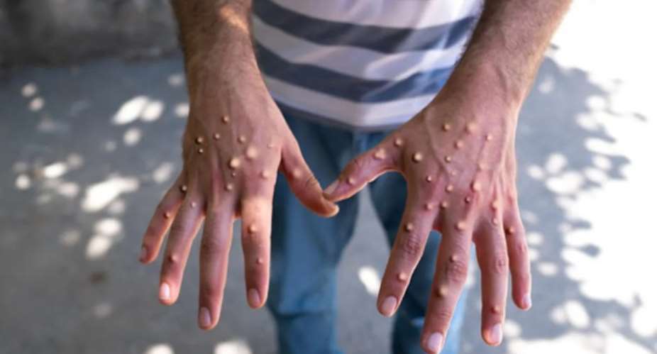 Ghana records 34 new Mpox cases, total rises to 79